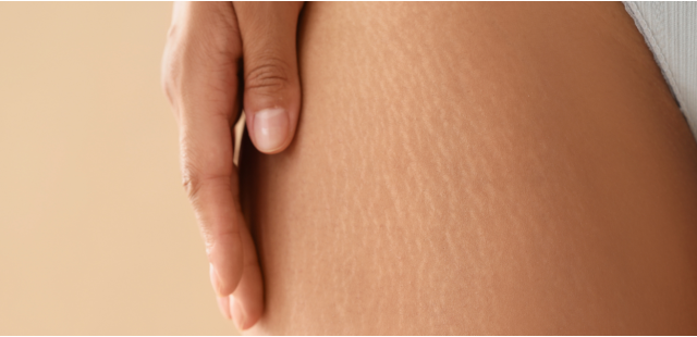Cellulite e Ritenzione: il piano d'attacco in 3 step