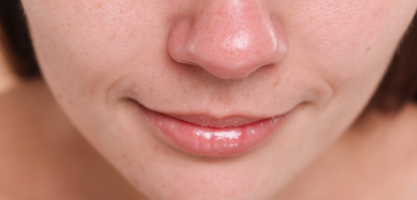 Punti neri su naso e viso: come si formano e i quali sono i migliori rimedi