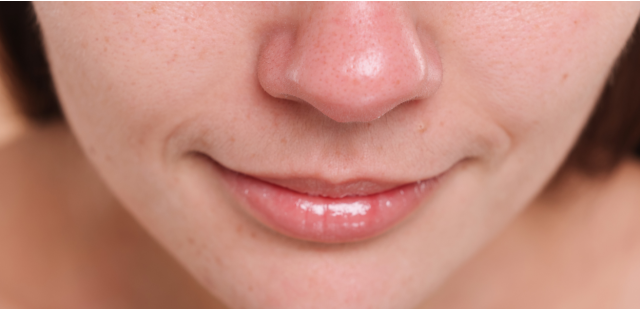 Punti neri su naso e viso: come si formano e i quali sono i migliori rimedi